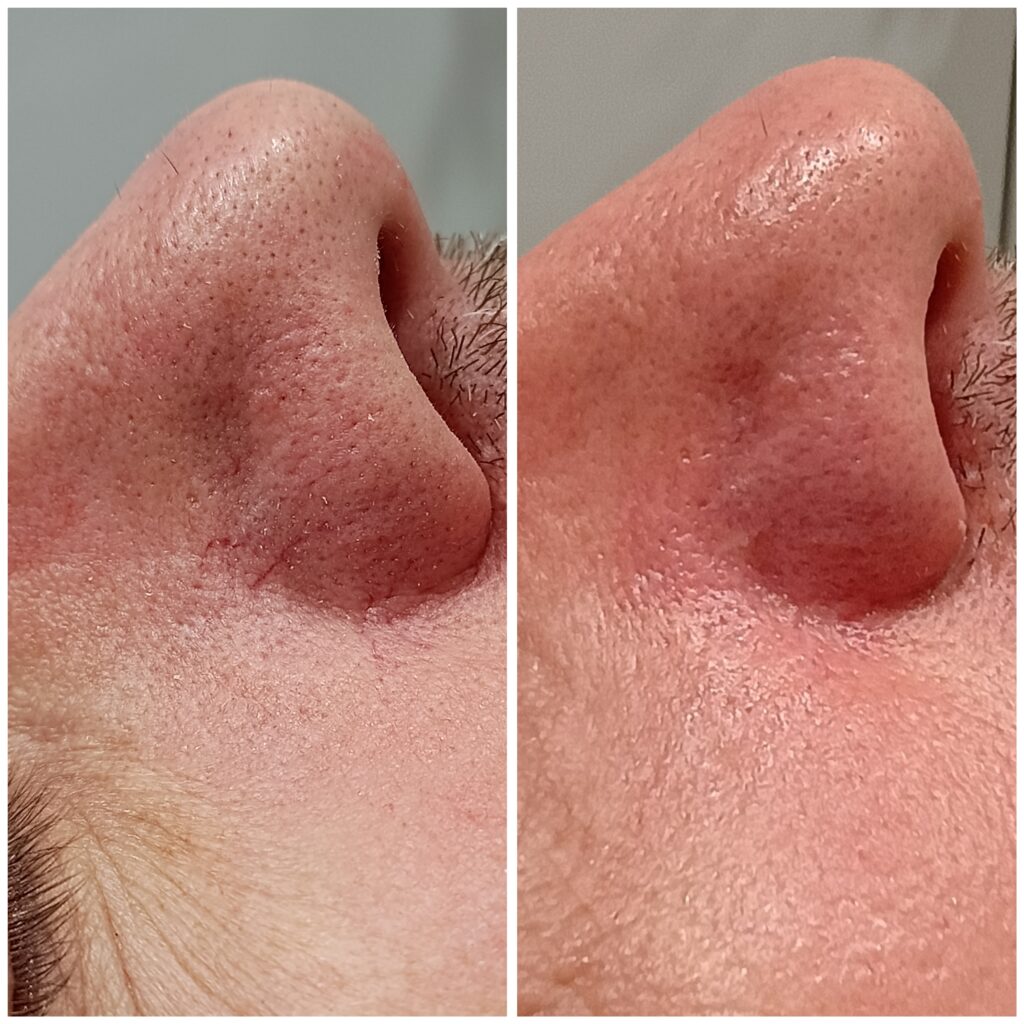 Zamykanie Naczynek  Znamion Rubinowych Bydgoszcz 01